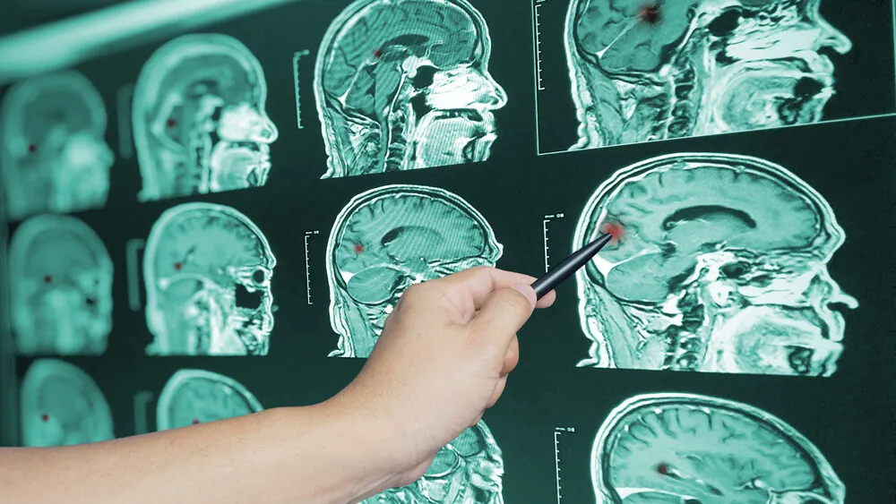 Florida Traumatic Brain Injury Lawyers